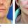 Why Choose A Minimally Invasive Facelift or Necklift? - II