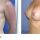 What are 3 Common Breast Implant Questions?