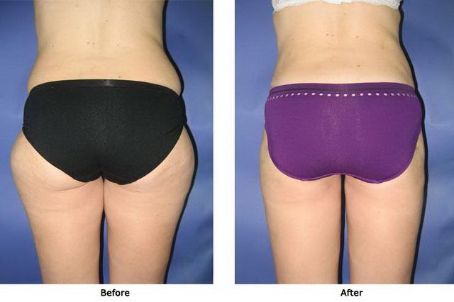 Liposuction 1 Flanks Outer Thighs and Inner Thighs