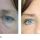 Blepharoplasty : Things You Must Know Prior to Undergoing Eyelid Surgery