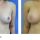 Teardrop Implants: Is it The Right Breast Augmentation Choice?